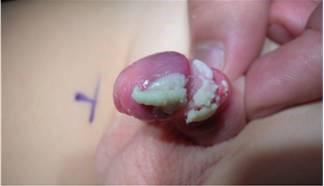 Napletek jest w stanie zapalnym 