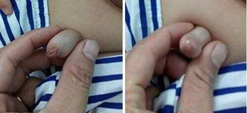 Wąski napletek u małych dzieci