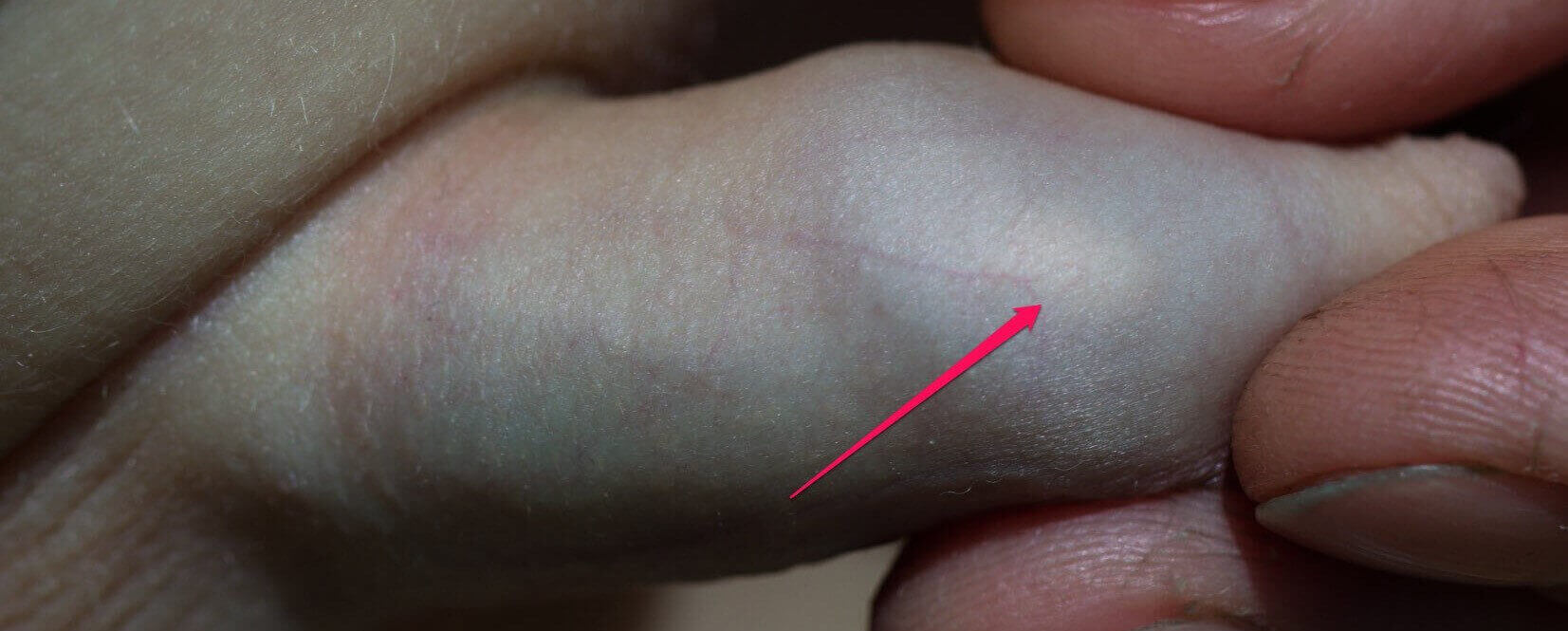 przyklejony napletek mastka u dziecka