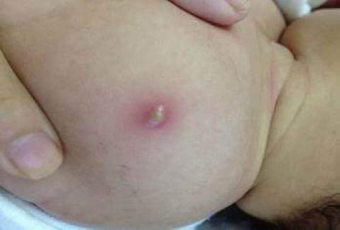 Czerwone i twarde miejsce po zastrzyku
