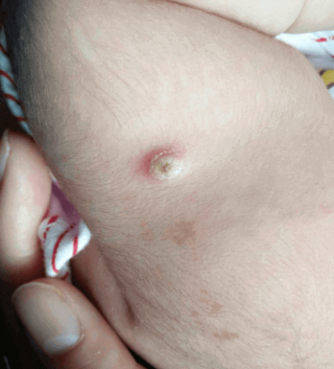 ropień po szczepieniu u niemowlaka