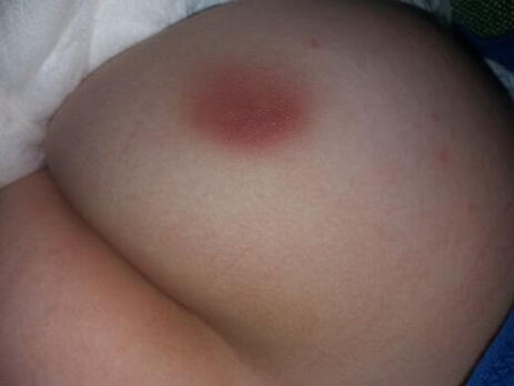 stan zapalny po zastrzyku w pośladek