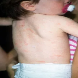 Łupież różowy Giberta wysypka u dziecka