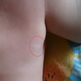 Bielactwo początki u dzieci 