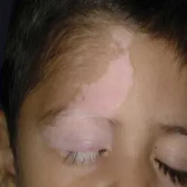 Bielactwo wrodzone u dziecka