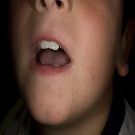 Brodawki na twarzy u dziecka