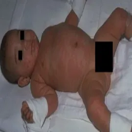 Choroba opryszczkowate zapalenie skóry u dziecka