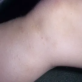 Choroba skóry u dziecka liszaj lśniący 