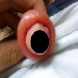 Choroba załupek u dziecka