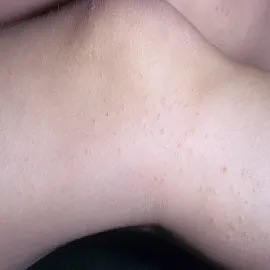 Liszaj lśniący u dzieci na nogach