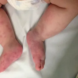 Małopłytkowość immunologiczna u dziecka