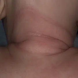 Objawy atopowego atopowe zapalenie skóry u niemowląt