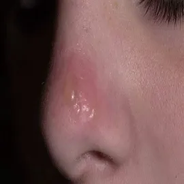 Opryszka zwykła na nosie