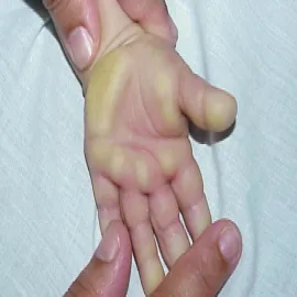 Rogowacenie skóry u dziecka