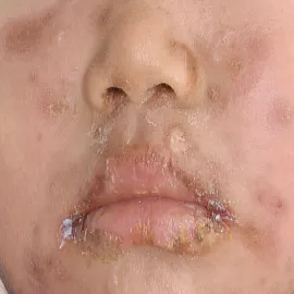 Skórne skutki uboczne działania leków