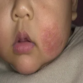 Wypryski na twarzy u dziecka AZS