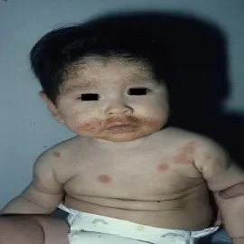 Wypryski na twarzy u niemowlaka AZS