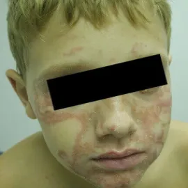 Zespół Sneddona u dziecka