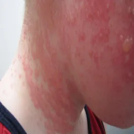 Alergia na słońce u dziecka na twarzy