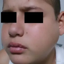 choroba świnka objawy u dzieci