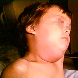 choroba świnka