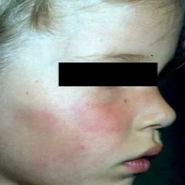 fifth disease