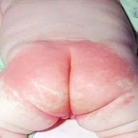 napkin dermatitis