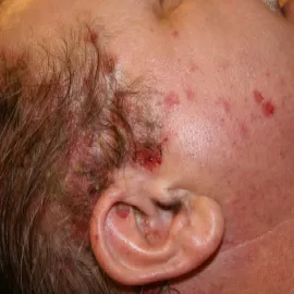 pęcherzyca zwykła u dziecka