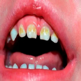 próchnica wieku dziecięcego