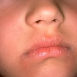 zapalenie kącików ust u dziecka