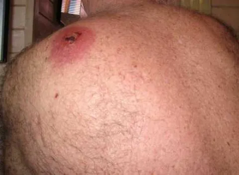Zdjęcie ugryzienia pająka na plecach