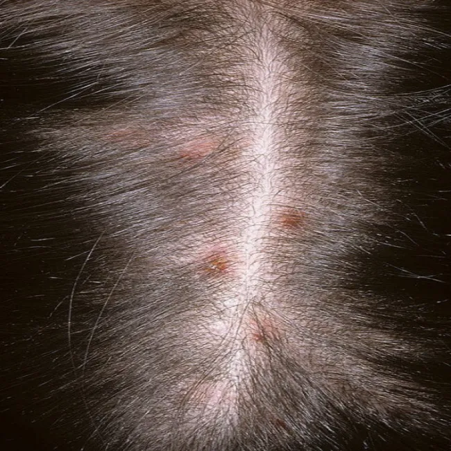 Świąd skóry głowy przeczosy