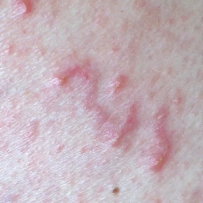 Świerzb przeczosy zdjęcie