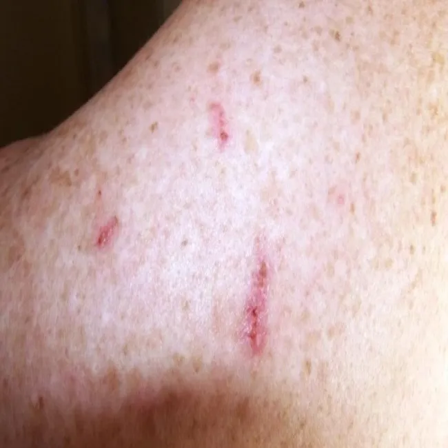 ślady zadrapań przeczosy 