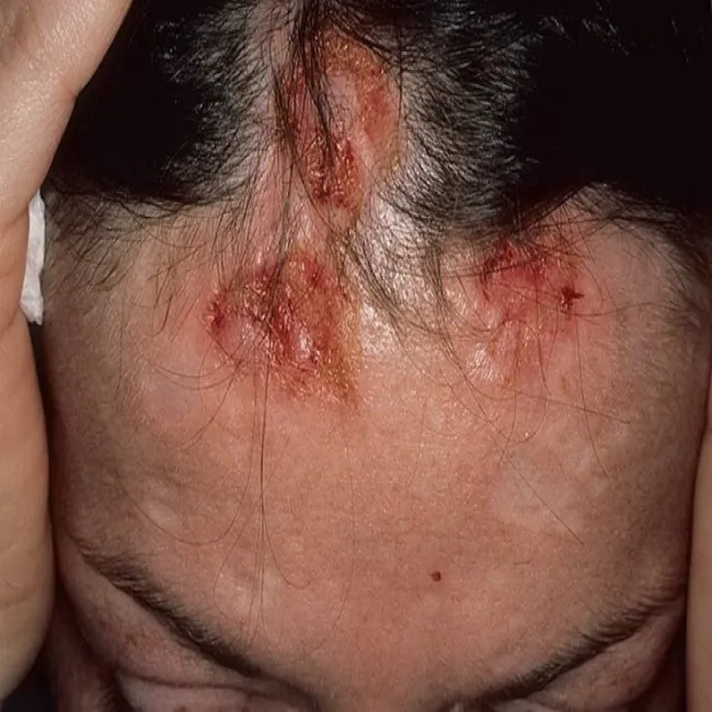 Drapanie głowy na tle nerwowym przeczosy