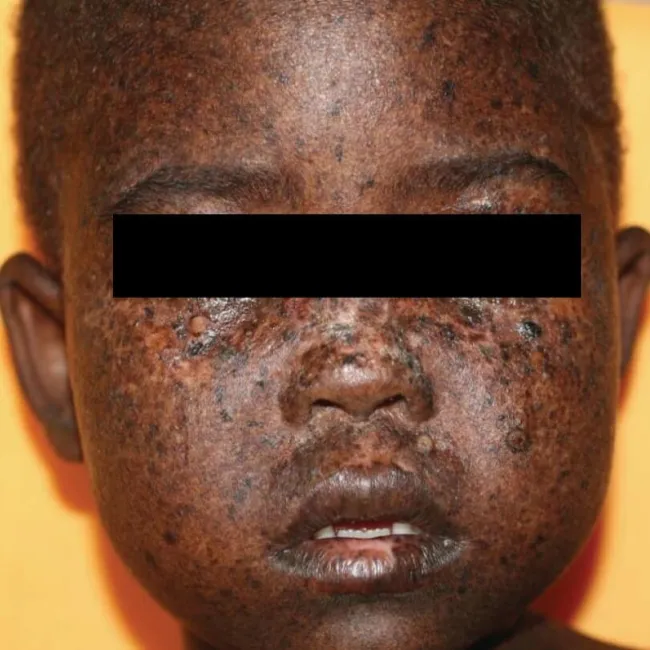 Genetyczna choroba genodermatoza 