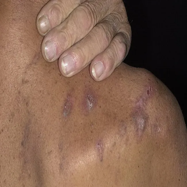 Kłucie skóry nerwica przeczosy