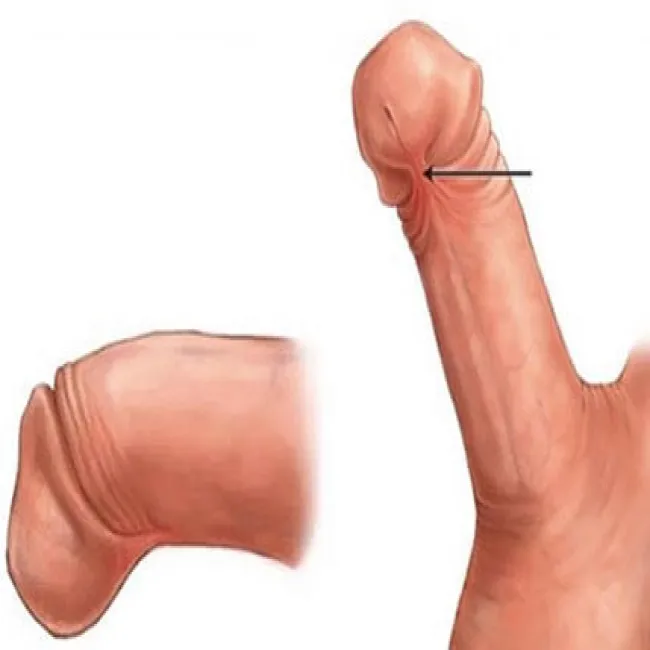 Krótkie wędzidełko prącia