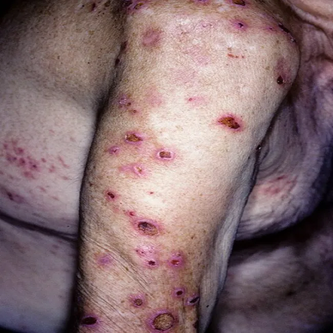 Nerwica lękowa pieczenie skóry przeczosy