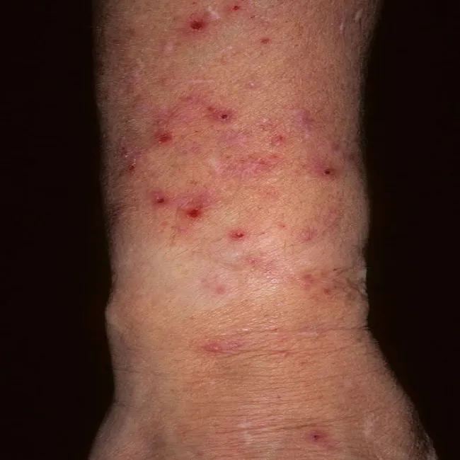 Nerwica pieczenie skóry przeczosy