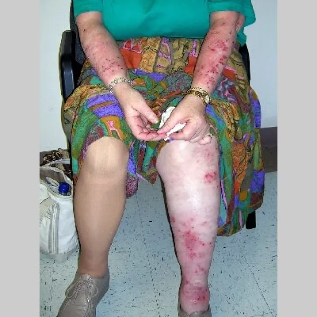 Nerwica skóry przeczosy