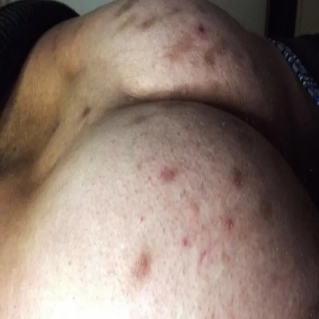 Pieczenie swędzenie pośladków przeczosy