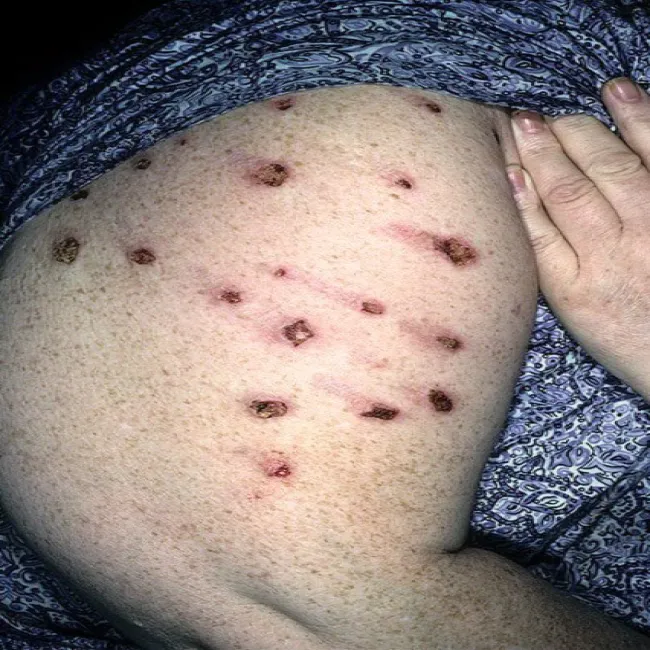 Przeczosy na rękach rany