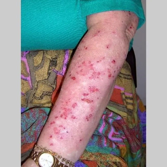 Przeczosy na tle nerwowym na ręce