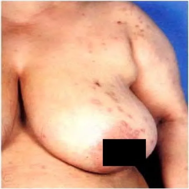 Przeczosy psychogenne na piersi