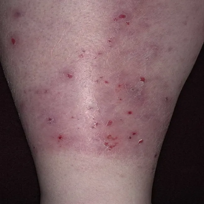 Przeczosy skórne psychogenne na łydce