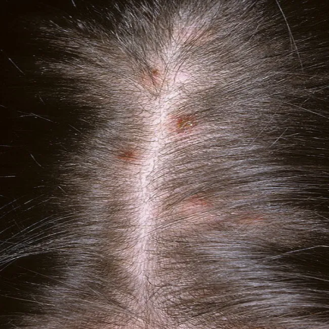 Swędząca skóra głowy  krostki przeczosy