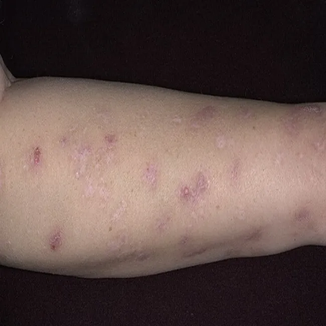 Swędzenie skóry bez objawów skórnych przeczosy