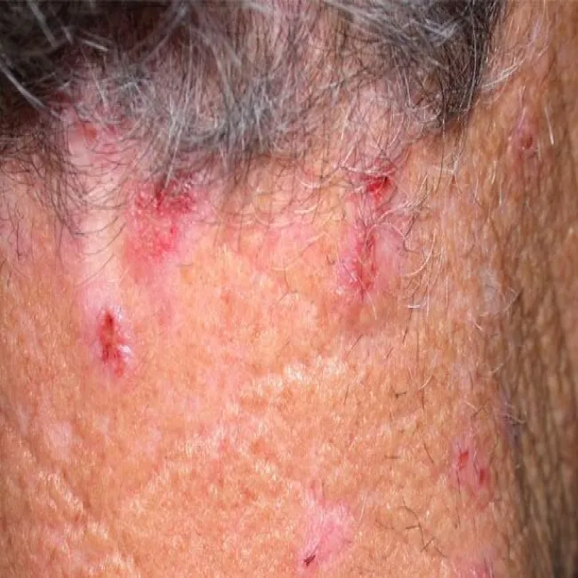 Zadrapania przeczosy na szyi