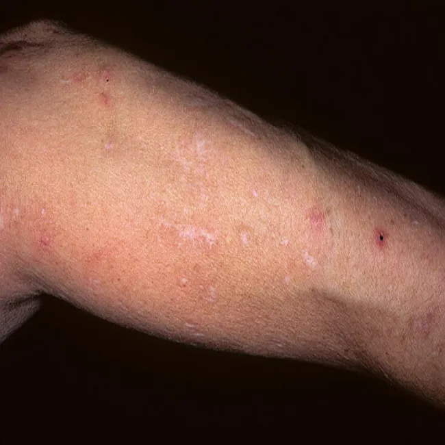 Zdjęcia zmian skórnych przeczosy